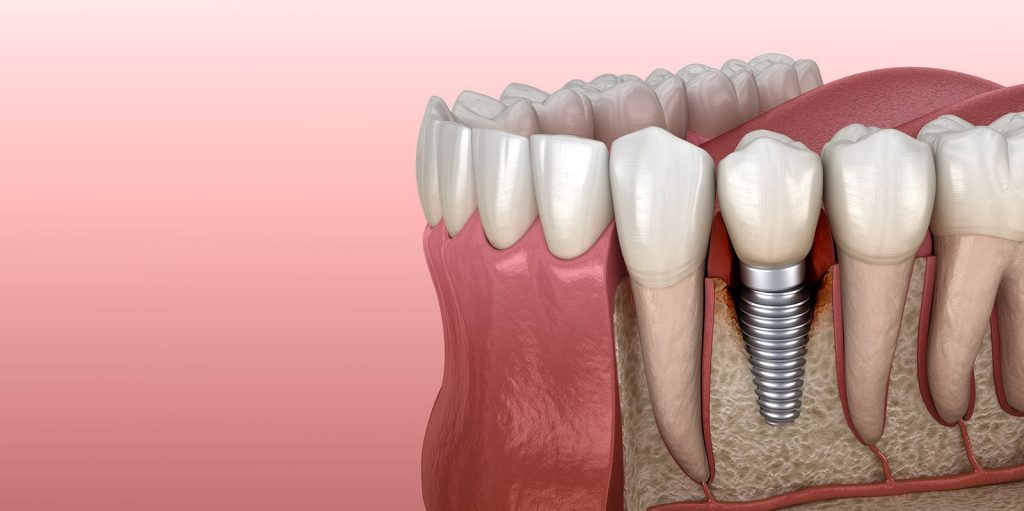 Your Complete Guide to Dental Implants in Des Moines