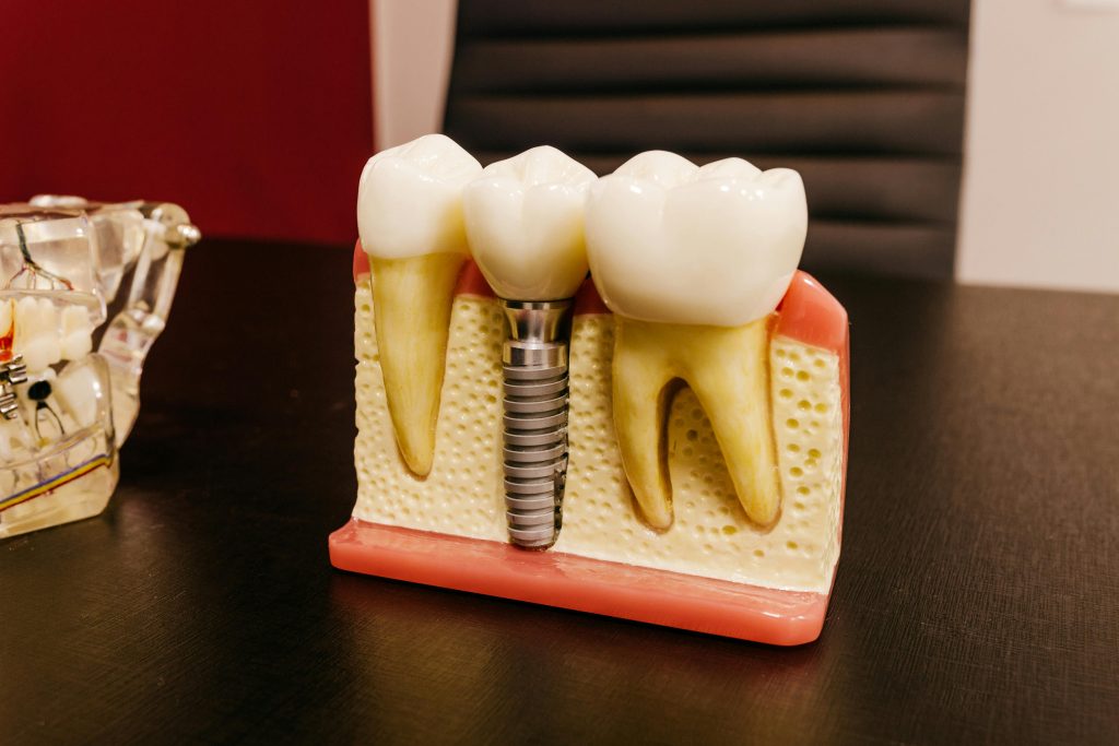 Your Complete Guide to Dental Implants in Des Moines
