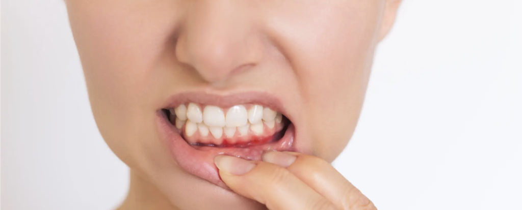 A patient consulting with their dentist for gum disease at All Smiles Dental in Des Moines.