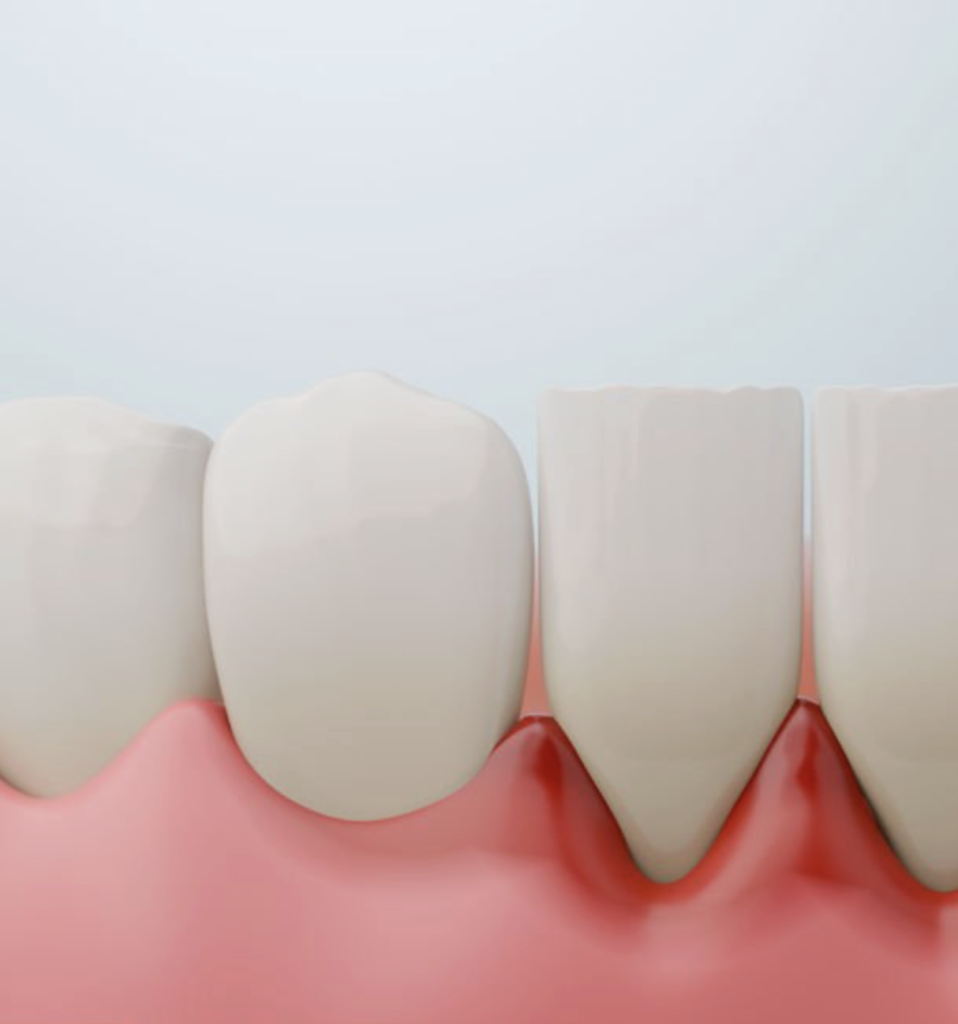 gum disease at All Smiles Dental in Des Moines.